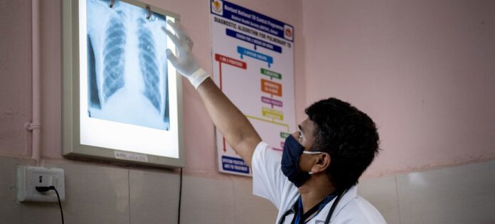 Um médico em Gujarat, Índia, verifica a radiografia de tórax de um paciente em busca de sinais de tuberculose ou outras infecções pulmonares Um médico em Gujarat, Índia, verifica a radiografia de tórax de um paciente em busca de sinais de tuberculose ou outras infecções pulmonares